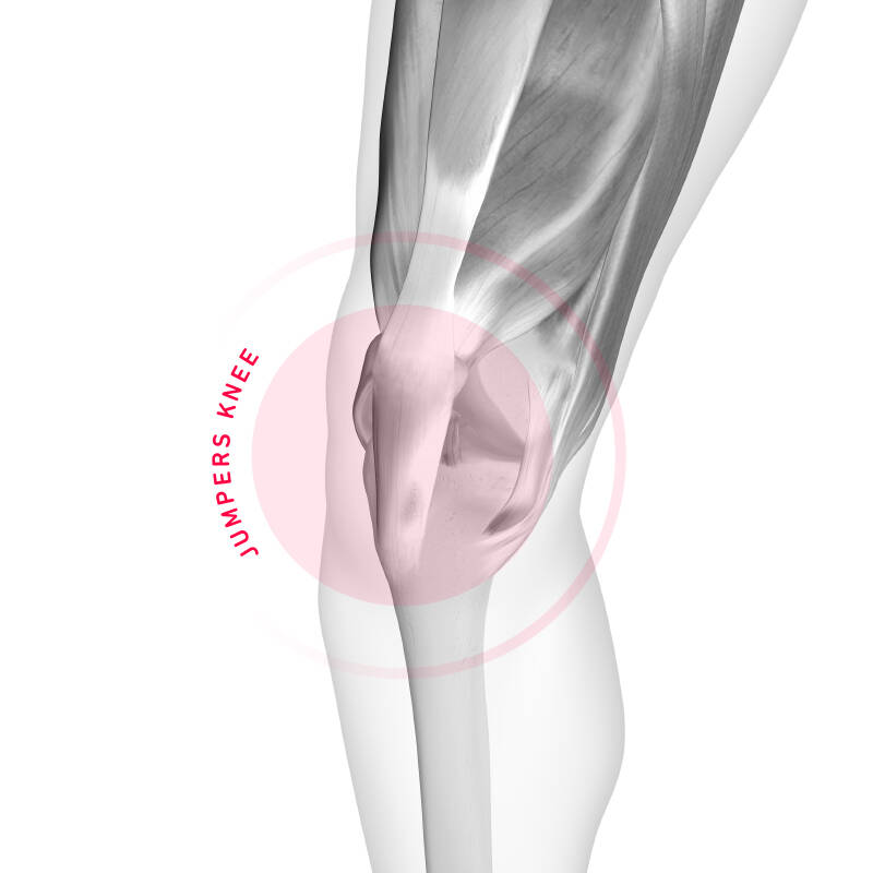 Schematic representation of the pain area in a knee knee