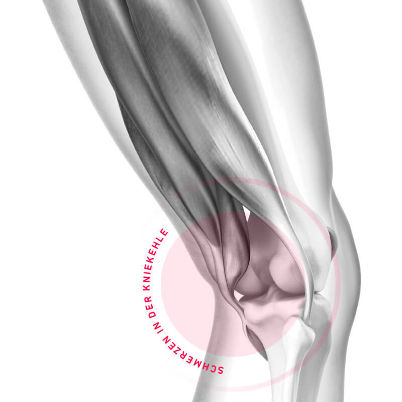 Schematic representation pain in the back of the knee