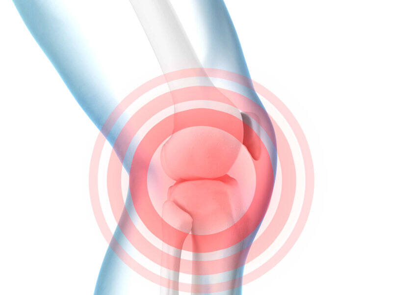 Schematic representation of knee pain on a model of the knee joint